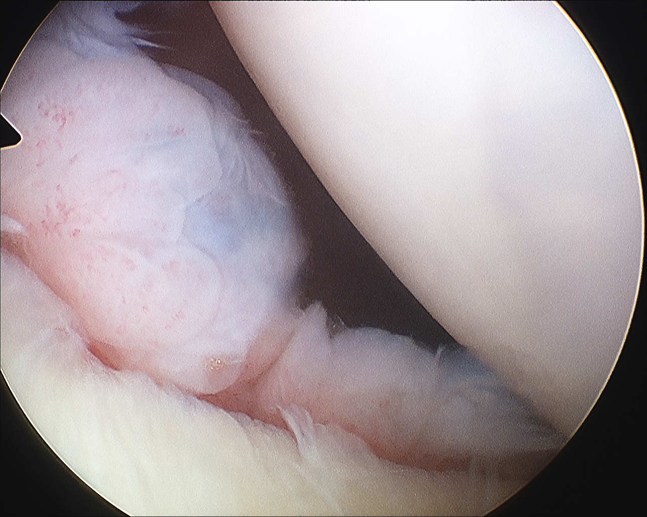 Anterior bankart lesion Arthroscopy